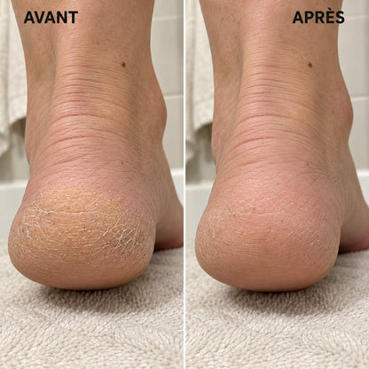 TalonDoux™ Râpe Pieds Double Face | Offre 1+1